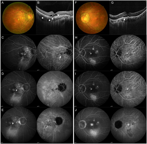 Figure 1. Example of a 53-year-old male patient with bilateral chronic central serous chorioretinopathy (cCSC). (A–E) Multimodal imaging at baseline from the affected right eye. (A) Fundus photography showed serous detachment at macular area with diffuse atrophic RPE in the right eye. (B) Spectral domain optical coherence tomography (SD-OCT) scan at baseline from the right eye showing presence of subretinal fluid (SRF) with serous pigment epithelial detachment (PED, arrows). Presence of posterior cystoid retinal degeneration (arrowhead), pachychoroid with dilated vessels in haller’s layer (asterisks) can also be visible. (C–E) Early-, intermediate- and late-phase images from fluorescein angiography (FA, left panel) and indocyanine green angiography (ICGA, right panel). (C,D) Diffuse hyperfluorescent areas due to increased transmission of the choroidal fluorescence as well as hyperfluorescent areas due to window defects, staining and accumulation were visible in the early and intermediate phase of FA. (E) Maintenance of hyperfluorescence in areas of dye staining and pooling was visible in the late phase of FA. In the early phase of ICGA, dilated choroidal vessels can be observed (arrow). In the mid-phase of ICGA, geographic areas of hyperfluorescence with blurred contours due to choroidal vascular hyperpermeability was visible, areas of RPE atrophy appeared hypofluorescent (D). Such mid-phase hyperfluorescent areas was washed-out, forming a hyporfluorescent with a blurred hyperfluorescent rings (E). (F–J) Multimodal imaging at baseline from the left eye affected by secondary choroidal neovascularization (CNV). (F) Fundus photography showed serous sub-macular detachment with pigmentary abnormalities in the left eye. (G) SD-OCT B-scan centred to the fovea showing the flat irregular PED with sub-RPE hyperreflectivity (double layer sign). (H–J) Early-, intermediate- and late-phase images from FA (left panel) and ICGA (right panel) showed hyperfuorescence at macula.