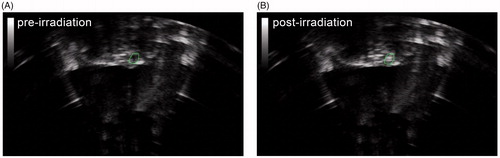 Figure 4. Sonogram showing subcutaneous nodules before and after HIFU ablation. (A) Before HIFU irradiation, the subcutaneous nodules in the rats were internally hypoechoic. (B) After HIFU irradiation, the target area was hyperechoic.