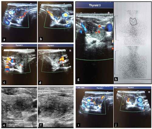 Figure 1. Thyroid ultrasonography of the cases. (a, b) First case. (a) Right lobe and (b) left lobe. (c, d) Second case. (a) Right lobe and (b) left lobe. (e, f) Third case. (e) Axial resolution and (f) longitudinal resolution of the left lobe. (g, h) Fourth case: (g) thyroid ultrasonography of the left lobe and (h) thyroid scintigraphy imaging. (i, j) Fifth case. (i) Right lobe and (j) left lobe.