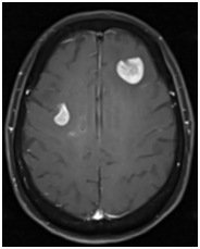 Figure 4. Brain MRI of further progressed primary central nervous system lymphoma. Brain MRI showed further progression on post-contrast T1 image after 2 cycles of (8 weeks) rechallenging biweekly high dose-methotrexate (HD-MTX), at 22 months since diagnosis.