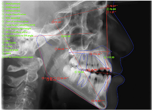 Figure 1 Lateral cephalogram showing the landmarks locations and measurements made using WebCeph.