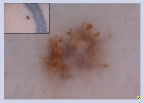 Figure 16. Atypical nevoid lesion.This asymmetric pigmented lesion reveals focal pseudopods, irregular blue–white veil and atypical network. This constellation of findings raises concern for melanoma. The lesion was excised and the histopathology was deemed to be consistent with a Spitz nevus.