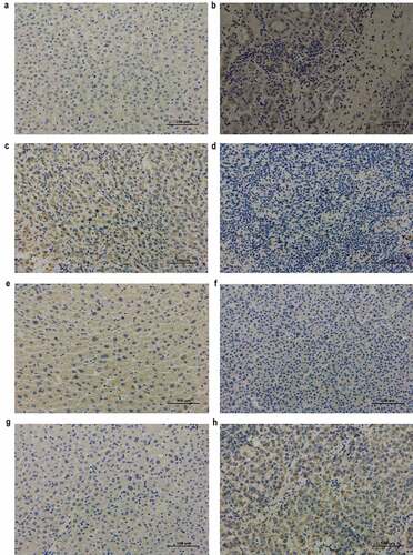 Figure 5. Immunohistochemical analysis of RRM2, FTCD, CYP2C9, and ATP6V1C1 in adjacent non-cancerous and cancerous tissues from HCC patients (original magnification, ×200)