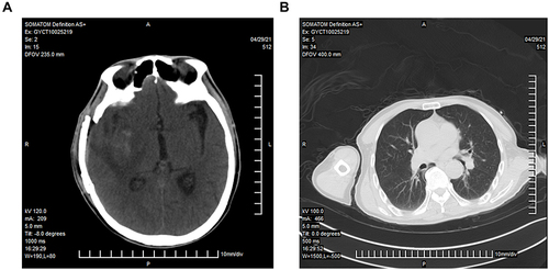 Figure 1 Head and lung CT scans of the patient after admission in our hospital. (A). Head CT showing a small amount of blood, effusion, and swelling of the surrounding soft tissue in the basal ganglia after intracerebral hemorrhage surgery. (B). Lung CT showing no obvious signs of infection.
