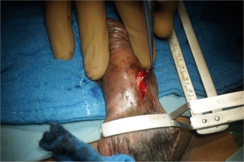 Figure 17 Coring the fistula tract till the underlying urethra.