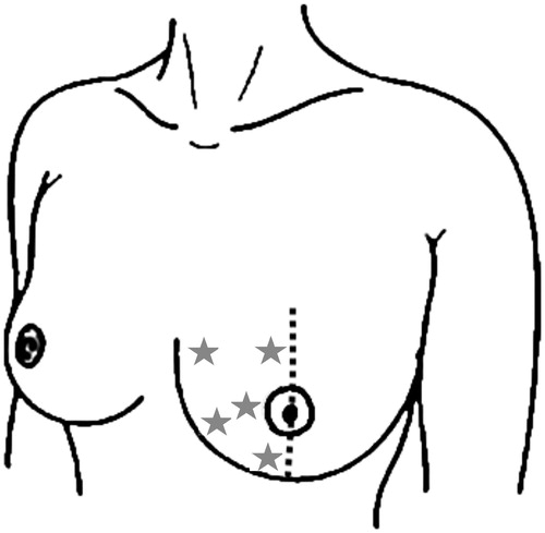 Figure 1. Locations of erythema measurements within a breast half. Measurement locations are indicated as stars. Measurements were performed analogously within the other breast half.