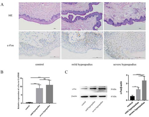 Figure 4. H&E staining (x100), immunoreactivity (x400), real-time PCR (RT-PCR) and western blot analysis of c-Fos in hypospadiac and control tissues. c-Fos expression was observed in both dermal and epidermal cells in human preputial genital skin. In patients with mild or severe hypospadias, the staining was mostly nuclear (A). c-Fos mRNA expression was significantly higher in subjects with hypospadias than in controls (p < 0.01, p < 0.01). However, no such difference was found between subjects with mild and severe hypospadias (B). c-Fos protein levels were significantly different between the control and hypospadias groups (p < 0.05, p < 0.001) and between the mild hypospadias group and the severe group (p < 0.01), suggesting a severity-dependent increase (C)