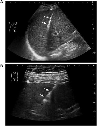 Figure 1 (A) Ultrasound image obtained during biopsy of the liver parenchyma of a 34-year-old man who had undergone liver transplantation 5 years previously (The needle track of biopsy is designated by the arrow). (B) Ultrasound image obtained during biopsy of a focal liver lesion in a 5-year-old boy (The needle track of biopsy is designated by the arrow).