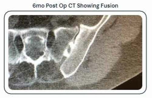 Figure 7. 6 month CT of Linq implant demonstrating bridging and solid fusion.