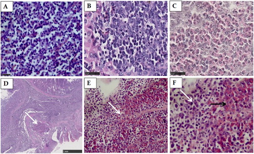 Figure 1. The spleen, liver and proventricular tissues stained by HE. (A) Numerous small lymphoid tumour cells scattered through the spleen. Scale bar = 25 μm. (B) The liver was infiltrated by the pleomorphic, neoplastic lymphoid tumour cells. Scale bar = 25 μm. (C) The liver was infiltrated by myeloid cells with eosinophilic cytoplasmic granules (myelocytes). Scale bar = 25 μm. (D) A large population of pleomorphic, neoplastic lymphoid tumour cells scattered in the proventricular glands and lamina propria of the proventriculus. Scale bar = 1 mm. (E) A higher magnification of the area indicated by an arrow in D. Scale bar = 50 μm. (F) A higher magnification of the area indicated by an arrow in (E). Two types of tumour cells exist in the same foci in the proventriculus, consisting of myeloid cells with eosinophilic cytoplasmic granules (myelocytes) (black arrow) and lymphoid tumour cells (white arrow). Magnification × 1000.