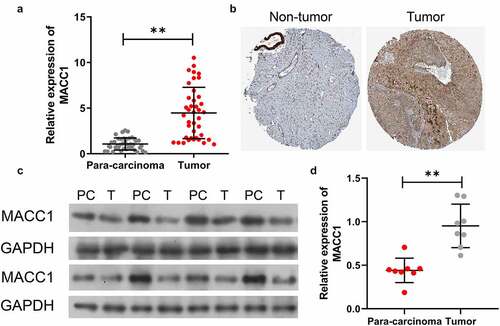 Figure 1. MACC1 was prominently upregulated in CC tissues. (a) The mRNA level of MACC1 in CC and para-carcinoma tissues was verified by qRT-PCR. (b) Immunohistochemical analysis of MACC1 in CC and corresponding non-tumor tissues through the Human Protein Atlas. (c and d) Western blot analysis of MACC1 protein expression in CC and para-carcinoma tissues, and the relative expressions of MACC1 were quantitatively analyzed in accordance with the gray values in each group