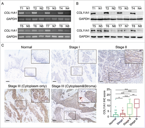 Figure 2. Expression of COL11A1 in ESCC samples. (A) and (B) SqPCR and western blotting analysis of COL11A1 expression in 8 paired ESCC tissues and the corresponding normal epithelial tissues. (C) Representative images of COL11A1 staining in normal and tumor samples. Immunoreactive intensity increased as cancer progressed (arrow: faint stroma expression). Scale bar, 100μm. * p<0.05, ** p<0.01, *** p<0.001.