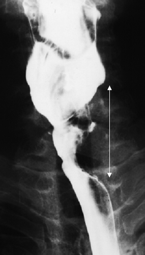 Figure 1.  Barium contrast esophagogram before radiotherapy showing a protruding tumor with ulceration, 6 cm in length, in the cervical esophagus (arrow).