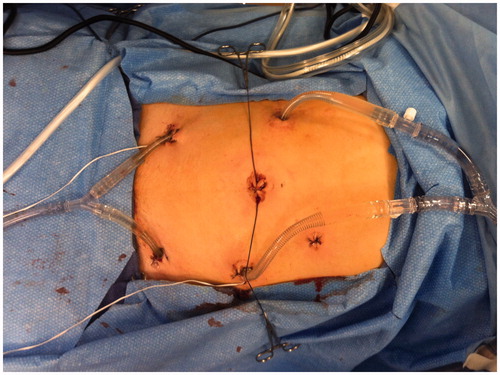 Figure 3. Laparoscopic administration of prophylactic hyperthermic intraperitoneal chemotherapy. The periumbilical incision was used for extraction of resected omentum/colon.