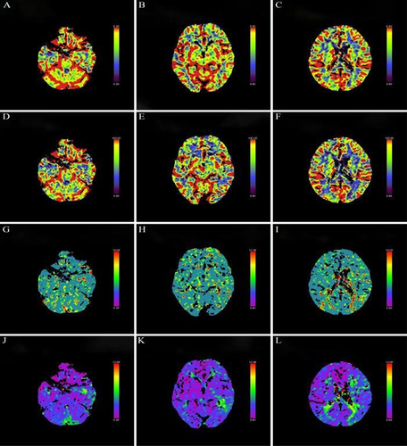 Figure 5 The same patient as Figure 4. Postoperative computed tomography perfusion (CTP) imaging showed that there was no significant difference in bilateral cerebral blood volume (CBV) (A–C), cerebral blood flow (CBF) (D–F), mean transit time (MTT) (G–I) and time to top (T-Max) (J–L).