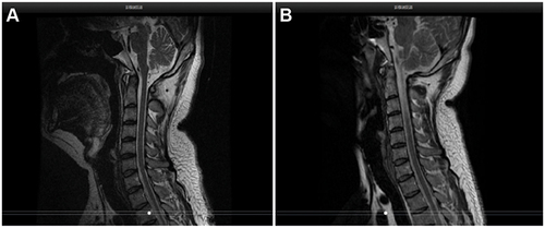 Figure 2 MRI images of the cervical spine. (A) MRI of the spine and Hip joint on April 8, 2020 indicated degeneration of the cervical vertebrae, abnormal changes in the bilateral sacroiliac and Hip joints with slightly swollen surrounding soft tissues, and swelling of the right obturator externus muscle. These were considered inflammatory lesions. (B) Image of the spine and Hip joint MRI on April 25, 2022 showed straightened physiological curvature of the cervical spine compared with the MRI results on April 8, 2020 before the use of biologics, with less severe bilateral sacroiliac joint inflammation.