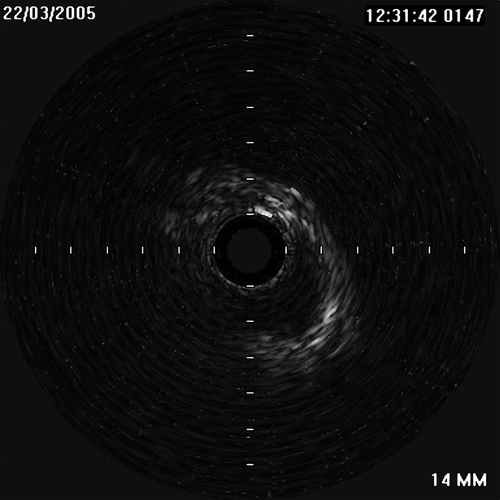 Figure 3 IVUS at the bent site of LMT, systole.