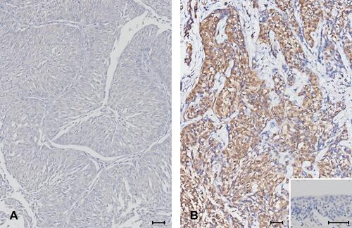 Figure 3 Increased COMP in muscle invasive (B) compared to non-muscle invasive (A) urothelial carcinoma (immunohistochemical staining). (Inset: tumor adjacent non-tumor urothelium) (original magnification: 400×).