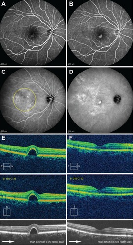 Figure 1 Fundus and optical coherence tomography findings in the right eye (Case 1).