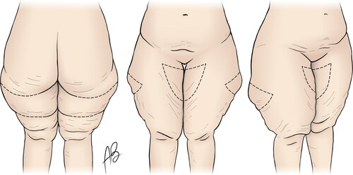 Figure 1. Preoperative markings of the helix thigh lift. The incision lines lie in the gluteal crease and the middle transverse thigh fold (left picture). The marked fold has to be pinched to simulate skin closure with no undermining. The surgical markings are tapered upwards over the anterolateral region of the thigh. On the medial aspect, a pinch test is used to assess the amount of skin excess. The anterior medial markings are tapered toward, but do not reach the inguinal crease (they stop about 2–3 cm distally) (middle and right pictures). See Supplemental Digital Content 1 - Video.