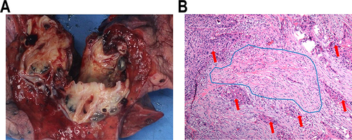 Figure 1 Representative images of pathological response after neoadjuvant immunotherapy. (A) The gross specimen of lung cancer after neoadjuvant immunotherapy; (B) pathological response after neoadjuvant immunotherapy in 200x microscope, red arrow: residual tumor cell, blue area: areas of inflammation and fibrosis.