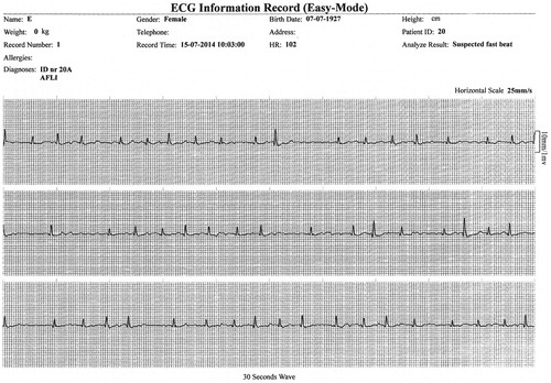 Figure 3. Example of a PEM recording. The figure shows the recorded results of a patient with AF. The PEM device shows the patient’s heart rate (HR) and suggests an analysis of the recording (analysis result). The remaining information including the diagnosis is provided by the operator.