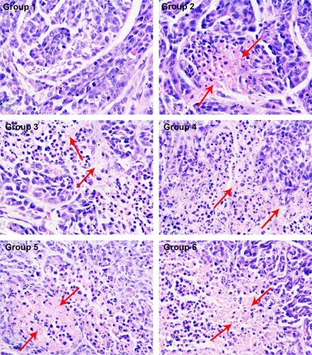 Figure 6 Histological examination of tumor tissues.Notes: The tumor tissues of the treatment groups displayed different degrees of necrosis (red arrows indicate necrotic tumor tissues). Tumor necrosis was the most extensive in group 6 (the necrotic areas are stained pink). Images of tissues stained with hematoxylin and eosin were captured at 200× magnification. (Group 1) negative control, (Group 2) free C225 therapy, (Group 3) radiotherapy, (Group 4) gene therapy combined with radiotherapy, (Group 5) free C225 combined with radiotherapy, and (Group 6) gene-loaded IMANS combined with radiotherapy.Abbreviation: C225, cetuximab.
