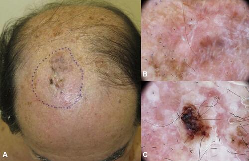Figure 9 Invasive melanoma on the parietal region in a 75-year-old man with androgenic alopecia, superficial spreading melanoma 3.3 mm Breslow thickness (A) The lesion appears partially nodular with not-defined borders. (B, C) In dermoscopy a unspecific pattern is detected with brownish pigmentation, white lines and milky red areas.