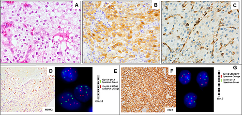 Figure 2 Histopathological, immunohistochemical, and molecular findings: stromal cells with clear to vacuolated cytoplasm and small round to oval nucleus intermingled with abundant delicate capillary vessels (A). Stromal cells show α-inhibin positivity (B). Capillary elements show VEGF positivity (C). MDM2 by IHC shows nuclear positivity in a high proportion of tumor cells (D), in accordance with the signal gains on MDM2 gene detected by FISH (E). EGFR by IHC shows membranous positivity in all tumor cells (F), also in accordance with the signal gains on EGFR gene detected by FISH (G).