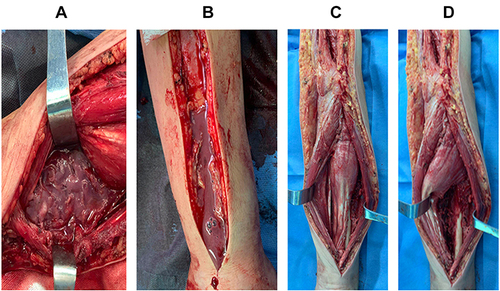 Figure 2 (A and B) Pus and gas were observed within the forearm musculature and intermuscular space during surgery. (C and D) Partial muscular necrosis and infection of the interosseous membrane and periosteum was observed.