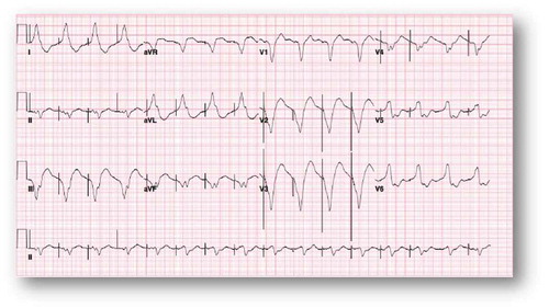 Figure 3. Ventricular paced rhythm at rate of 95 bpm with still wide QTc interval (688 msec).