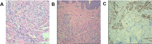 Figure 2 The laboratory examination. (A and B) Ill-defined nodular areas were found in the dermis; novel and immature vessels can be seen in the nodes; hyperplasia for the mesenchymal spindle cells; angiomatous changes can be observed in the focal area, which follows the character of KS; (C) Immunohistochemical examination: CD34(+); Fli-1(+); HHV8(-); Ki-67(30%+); D2-40(+).