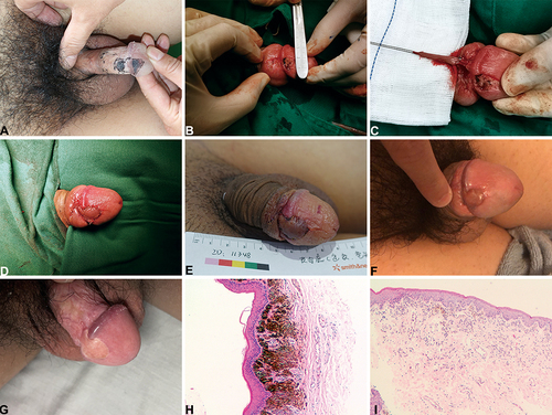 Figure 1 Flap design and flowchart of Case 5. (A) Preoperative divided nevus position. (B) Lesion site excision extension. (C) Designed flap. (D) Immediate outcome after surgery. (E) The penis and glans position first day after surgery. (F) The penis and glans position about 6 months after surgery. (G) The penis and glans position about 27 months after surgery. (H and I), (H) Glans position, (I) Inner prepuce plate position. For the histopathology, HE staining indicated intradermal nevus under a magnification of 100×.