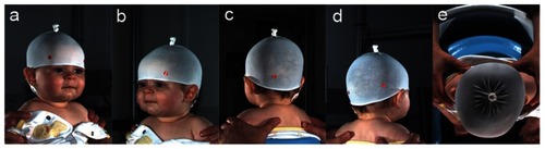 Figure 3 Five camera viewpoints of the head of a patient with deformational plagiocephaly. Camera views: a) half profile front right, b) half profile front left, c) half profile back left, d) half profile back right, e) from above.