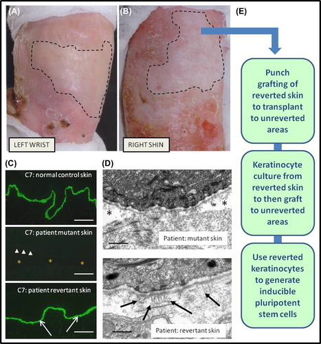 Figure 6. Clinicopathological features of revertant mosaicism in a patient with recessive dystrophic EB and potential clinical translation for therapy. There are demarcated areas in which trauma-induced blistering does not occur on the left wrist (A) and right shin (B). Immunolabelling of the dermal-epidermal junction (C) with an antibody to type VII collagen (C7) shows bright linear staining in normal skin but a complete absence in patient skin (arrow-heads indicate dermal-epidermal junction, and asterisk denotes subepidermal blistering). In contrast, in the revertant areas there is bright linear labelling for type VII collagen (arrows) which resembles normal skin (scale bar = 50 μm). Ultrastructurally (D), the patient's blister-prone skin shows focal blistering beneath the lamina densa (asterisk), whereas in the area of revertant mosaicism there is no blistering and also evidence of new anchoring fibrils (arrows) that are completely lacking in the blistered skin (scale bar = 0.2 μm). The phenomenon of revertant mosaicism presents several opportunities for translational research and therapy (E), including culturing the reverted keratinocytes, skin grafting, and creation of inducible pluripotent stem cells.
