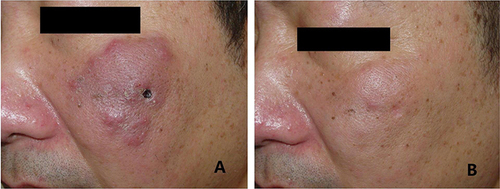 Figure 1 (A) Clinical manifestations before treatment (The scab is caused by the biopsy). (B) Significant improvement of the lesions after 3 weeks.