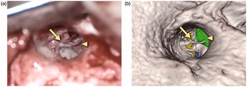 Figure 12. Snapshots comparing the actual (a) and virtual (b) procedures for a 35-year-old man who presented with right conductive hearing loss secondary to a middle ear globus tympanicum tumor. The operative photograph shows the external auditory canal as seen through the microscope. The tympanomeatal flap has been retracted anteriorly to show the middle ear contents. The ossicles can be seen with the arrow pointing to the manubrium of the malleus. The triangle identifies the tumor, shown in green in the simulation view.