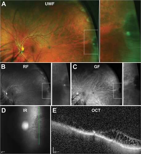 Figure 3. 31 year old Caucasian male with an oral bay and oral pearl in the far temporal peripheral retina visible on (A) UWF imaging and associated (B) red-free and (C) green-free images. (D) En face, infra-red imaging and (E) peripheral OCT through the structure demonstrates separation of the retinal layers at the bay. Abbreviations: IF, infra-red; OCT, optical coherence tomography. All other abbreviations as in .Figure 2