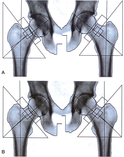 Figure 1. Zero rotation position (A) and 10–15° external rotation position (B) in bilateral femoral DXA scans. In the latter, the external rotation shows the prominence of the lesser trochanter.