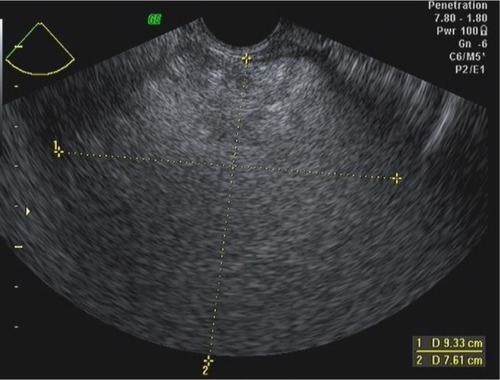 Figure 3 Transvaginal ultrasound in a 70-year-old woman.