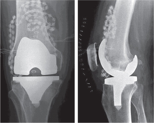 Figure 2. Radiographic appearance of a TKR in 2 directions. Gentamicin-PMMA beads are visible in the suprapatellar bursa and on the lateral side of the joint. Beads cannot be positioned in the posterior joint due to the limited space.