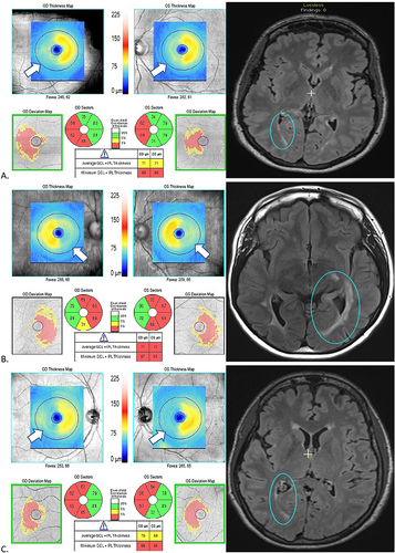 Figure 2 MRI and OCT findings in three patients (A, B, C) with multiple sclerosis and homonymous, hemi-macular ganglion cell + inner plexiform layer (GCIPL) atrophy in conjunction with posterior visual pathway lesions, a pattern which is thought to be indicative of retrograde trans-synaptic degeneration. In each case (A, B, C), the FLAIR MRI sequence demonstrates a unilateral lesion in the occipital white matter (blue circles), while the macular OCT shows a homonymous, hemi-macular GCIPL thinning with temporal hemi-atrophy in the ipsilateral eye and nasal hemi-atrophy in the contralateral eye. This is demonstrated by the “blue range” hemi-macular color in the thickness map of each OCT scan. In the quantified sectors which provide average GCIPL thickness in each of these sectors, the red sectors correspond to sectors with significant GCIPL thinning (below 1st percentile of healthy individuals of similar age). This is also depicted in the deviation maps, in which thinned areas are delineated in yellow (1st-5th percentile of healthy individuals of similar age) or red (<1st percentile of healthy individuals of similar age).
