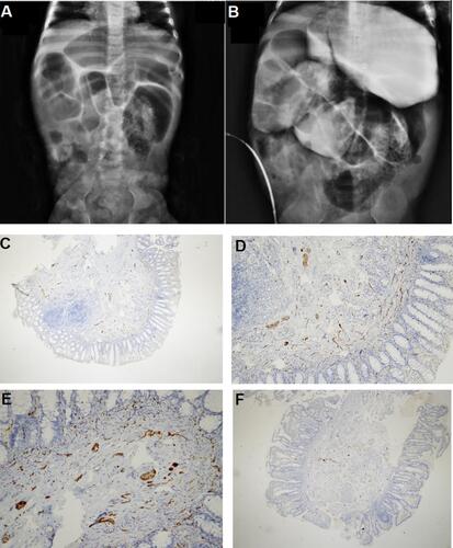 Figure 4 Imaging tests for proband II-1 in family F2. (A and B) Abdominal X-ray and barium study showing severe dilated bowel loops. (C and D) Calretinin staining 2 cm away from the anal verge, 4 cm from the anal verge (E), and from the ileostomy site (F). Ganglion cells are present (magnification: 40×, 100×, 200×, and 40× for C, D, E, and F, respectively).