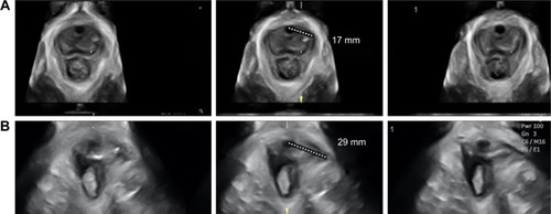 Figure 4 Measurement of the levator–urethra gap (LUG) on tomographic ultrasound imaging (TUI).