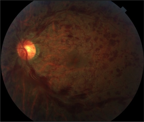 Figure 1 Color fundus photograph of the left eye demonstrates dilated, tortuous retinal veins with intraretinal hemorrhages in all four quadrants.