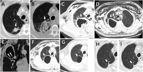 Figure 4. A 74-year-old man with lung cancer in the right upper lobe of the lung was treated with percutaneous microwave ablation (MWA). (A) solid GGO (white arrowhead) located in the right upper lobe of the lung. (B) A CT image obtained 24 h after MWA showing a larger fried-egg sign (white arrowhead) on the ablation zone. (C) A CT image obtained six days after MWA showing an enlarged cavitation (white arrowhead) with a maximum diameter of 71 mm, accompanied by subcutaneous emphysema. (D) A CT image obtained 11 days after MWA showing a cavitation continuing to enlarge and increased symptoms of subcutaneous emphysema. (E) A sagittal CT showing that the cavity was directly connected with the large bronchus. (F) A CT image obtained 37 days after MWA showing shrinking cavitation (white arrowhead), with subcutaneous emphysema being controlled. (G) A CT image obtained 3 months after MWA showing shrinking cavitation (white arrowhead). (H–I) CT images obtained 1 and 2 years after MWA showing the disappearance of cavitation and shrinking as a scar (white arrowhead).