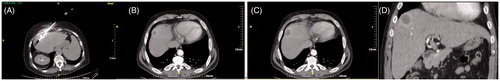 Figure 2. (A) Computed tomography axial scan without IV contrast medium injection – microwave antenna is placed in the centre of an HCC tumour located subcapsularly at the hepatic dome. (B) Computed tomography axial scan post-IV contrast medium injection in arterial phase immediately postablation – the ablation zone covers the whole tumour plus a safety margin. (C) Computed tomography axial scan post-IV contrast medium injection in portal venous phase immediately postablation – the ablation zone covers the whole tumour plus a safety margin. (D) Computed tomography coronal reconstruction post-IV contrast medium injection in portal venous phase immediately postablation – the round ablation zone covers the whole tumour plus a safety margin.
