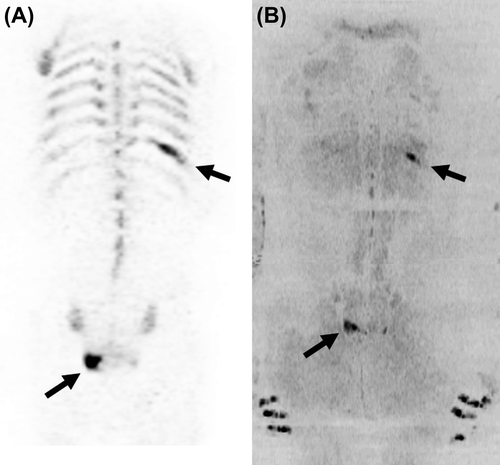 Figure 2. Coronal 18F-NaF PET and DWI, inverted signal intensity of trace image b-value of 1000 s/mm2, of the same 69-year-old prostate cancer patient as displayed in Figure 1. The lesions in the 10th rib on the left side and right lower part of sacral bone (marked by black arrows) were highly suspicious for being bone metastases similarly to SPECT (Figure 1) and SPEC/CT (not shown) while the lesion in sacral bone was missed and the in the 10th rib was considered as equivocal on bone scintigraphy. These highly suspicious lesions were suggestive to be bone metastases based on clinical and imaging follow-up, demonstrating a limitation of bone scintigraphy for the detection of bone metastases in prostate cancer patients.