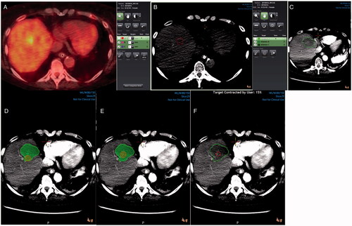 Figure 2. 3 D margin assessment in a patient with colorectal liver metastasis in segment 8. Pre-ablation PET/CT scan showing the tumor (A). Tumor segmentation (red) in a pre-ablation CT scan (B). Ablation zone segmentation (green) in a post-ablation contrast-enhanced CT scan (C). Tumor (red) and ablation zone (green) registration without target movement showing ablation margins <5mm (D). Tumor (red) and ablation zone (green) registration with target movement to match anatomic landmarks (E). Tumor (red) and ablation zone (green) registration with target movement and tissue contraction algorithm applied (F).