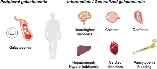 Figure 3. Schematic illustration of the clinical phenotype in patients with peripheral, intermediate, and generalized galactosemia III. in peripheral galactosemia, GALE dysfunction is restricted to the circulating blood cells, especially red blood cells, and the common clinical manifestation is galactosemia. In intermediate/generalized galactosemia, GALE dysfunction can be detected in multiple tissues, and therefore, patients present with syndromic manifestations, that may include neurological disorders, learning difficulties, delay growth, sensorineural hearing loss, early-onset cataracts, cardiac failure, hepatomegaly and hyperbilirubinemia, and pancytopenia associated with increased bleeding tendency. Image resource: Servier Medical Art (https://smart.servier.com/).